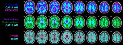 Periventricular and juxtacortical characterization of UManitoba-JHU functionally defined human white matter atlas networks